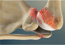 Peties ligos - lengva artrozė (osteoartritas) ir pažeistas petis