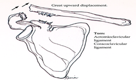 Peties sąnario traumos - Raktikaulio ir mentės ataugos atsiskyrimas (Acromioclavicular Separation / A/C)